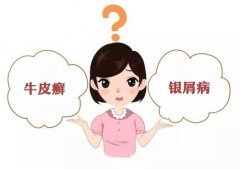 荨麻疹反反复复怎么治疗？